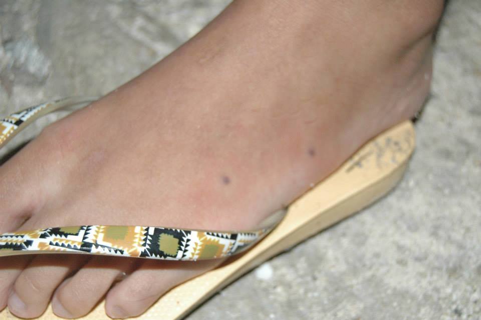 Sea Urchin Sting, Malapascua Island, Cebu